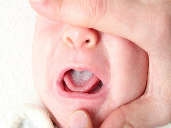 Nguyên nhân bệnh nấm lưỡi ở trẻ