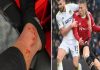 Tin bóng đá Anh 21/2: Scott McTominay đổ máu sau trận thắng Leeds