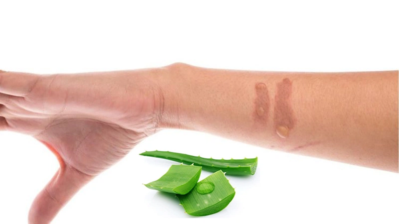 Mẹo trị bỏng dầu mỡ tại nhà bằng nha đam Mẹo trị bỏng dầu mỡ tại nhà bằng nha đam