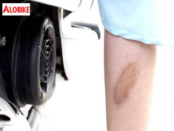 Cách sơ cứu và trị bỏng bô xe máy hiệu quả ngay tại nhà