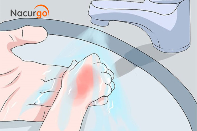Làm mát vết bỏng bằng nước sạch