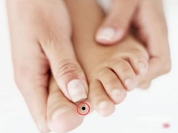 Nốt ruồi kẽ ngón chân ở nữ giới