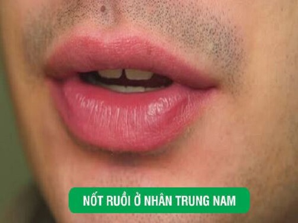 Nốt ruồi giữa nhân trung nam – Dấu hiệu bản lĩnh và sự nghiệp