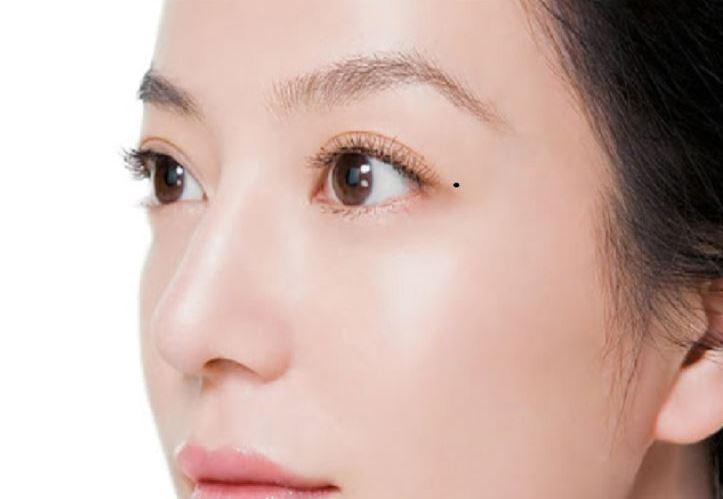 Mụn ruồi ở đuôi mắt phải tốt xấu?